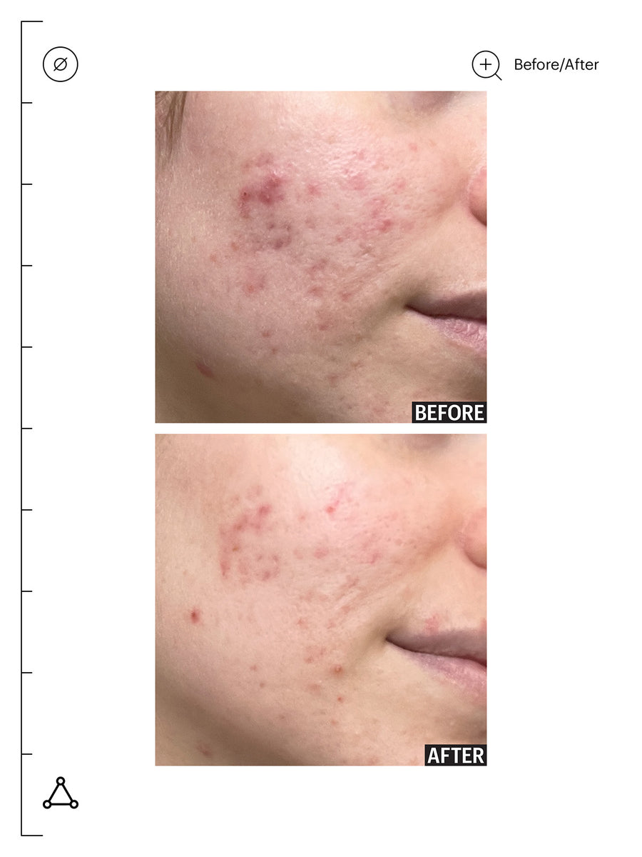 Promise Keeper Nightly Blemish Treatment