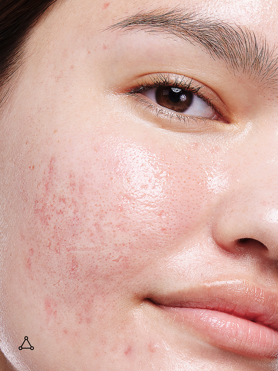Promise Keeper Nightly Blemish Treatment