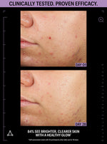 acne clearing serum before after