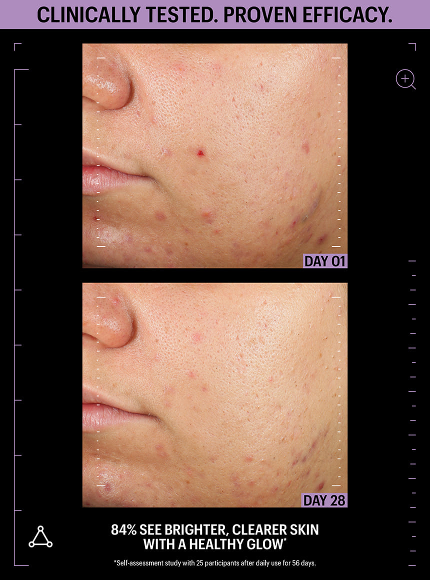 acne clearing serum before after
