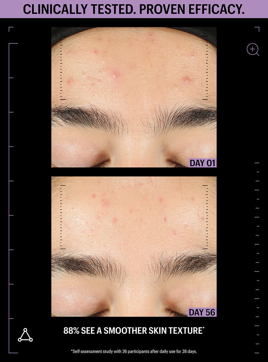 kojic acid and azelaic acid together