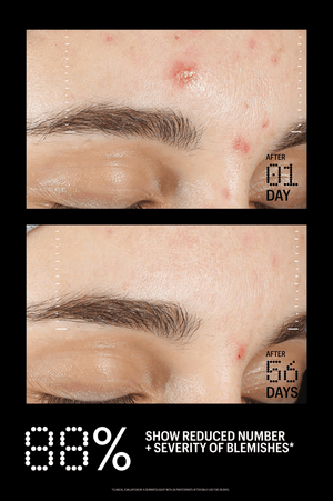 Azelaic & Kojic Advanced Clarifying Serum